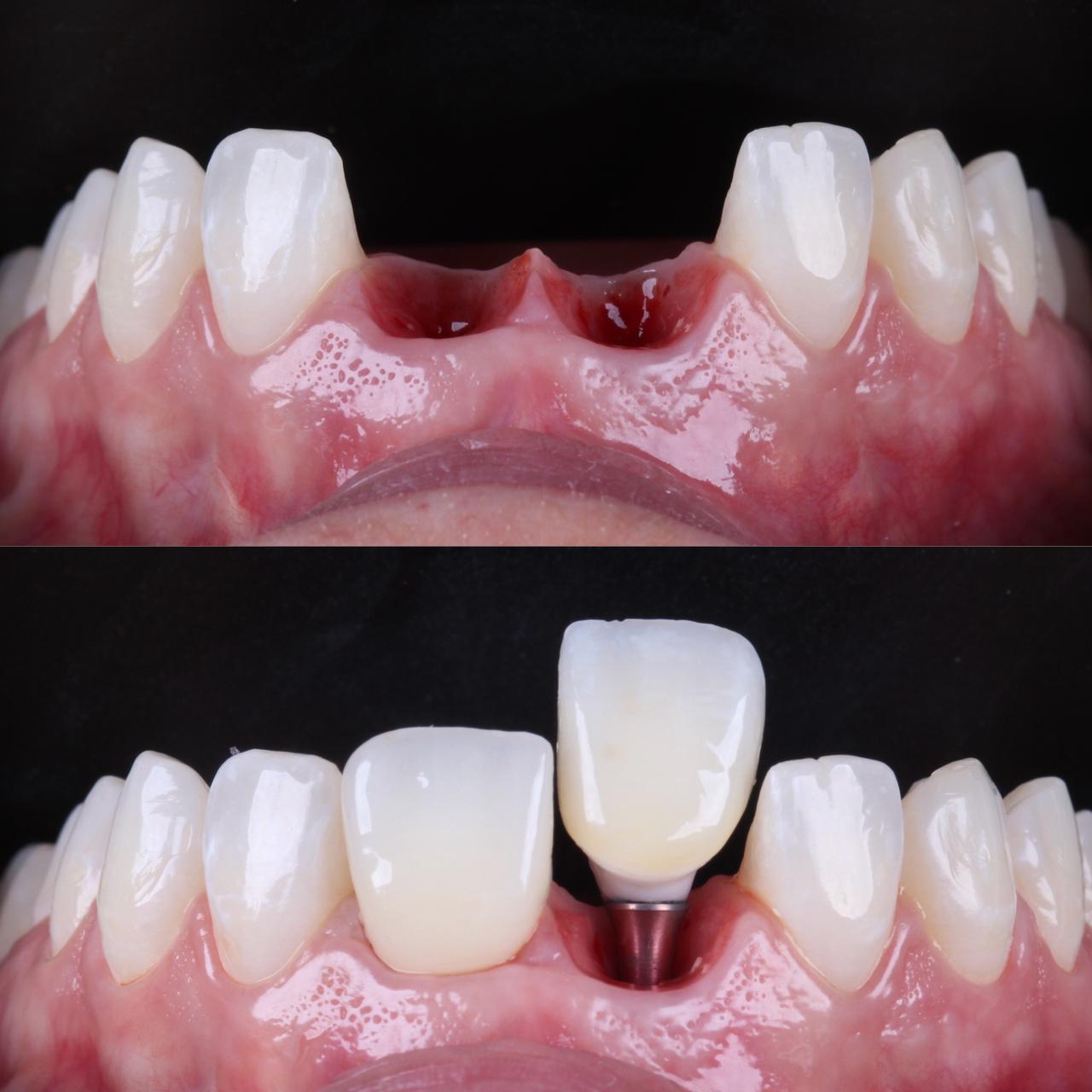 Vue odonto implante antes e depois (1)