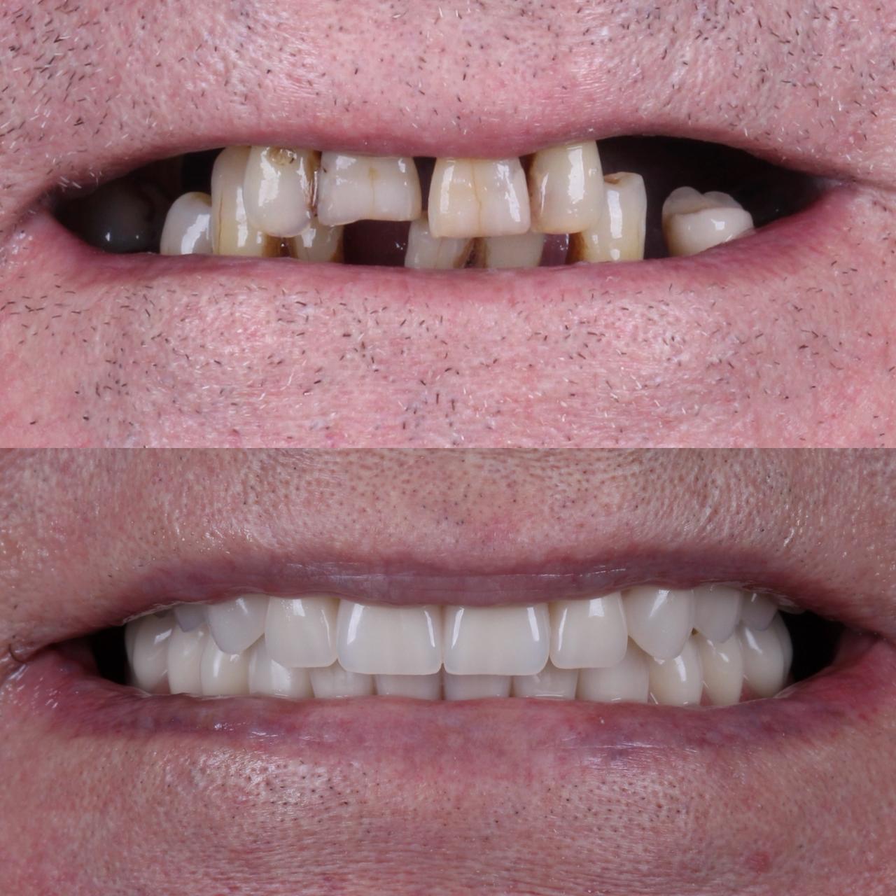 Vue odonto implante antes e depois (2)